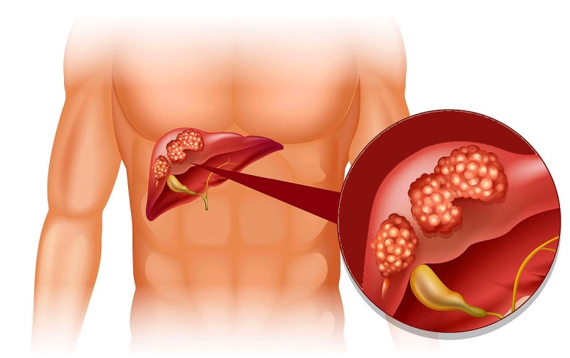 کیست کبدی چیست؟ علائم، تشخیص و روش‌های درمان