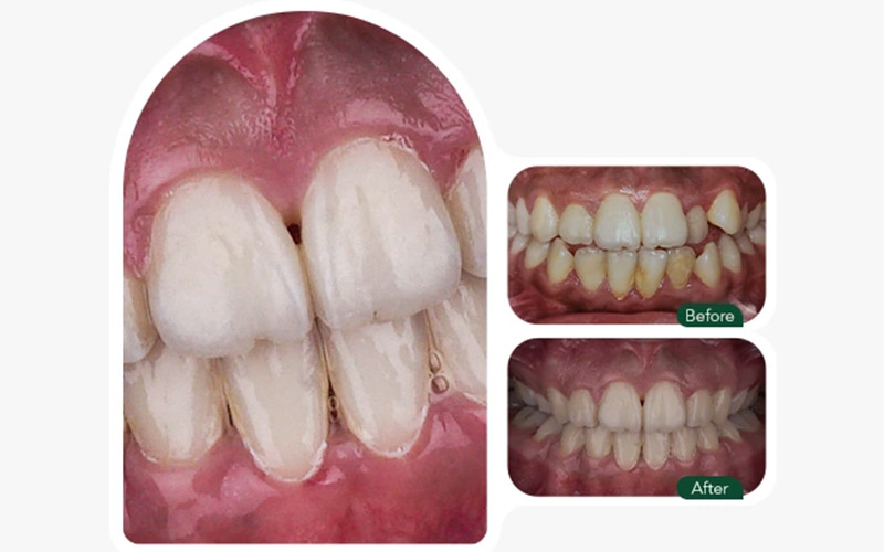 قبل و بعد ارتودنسی دندان در بارانا