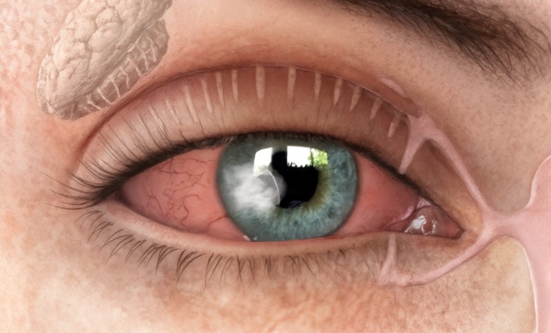 چه افرادی بیشتر در معرض خطر زخم قرنیه هستند؟