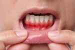 ارتباط بیماری لثه با تنگی دریچه قلب؛ باکتری دهان چگونه به قلب آسیب می رساند؟