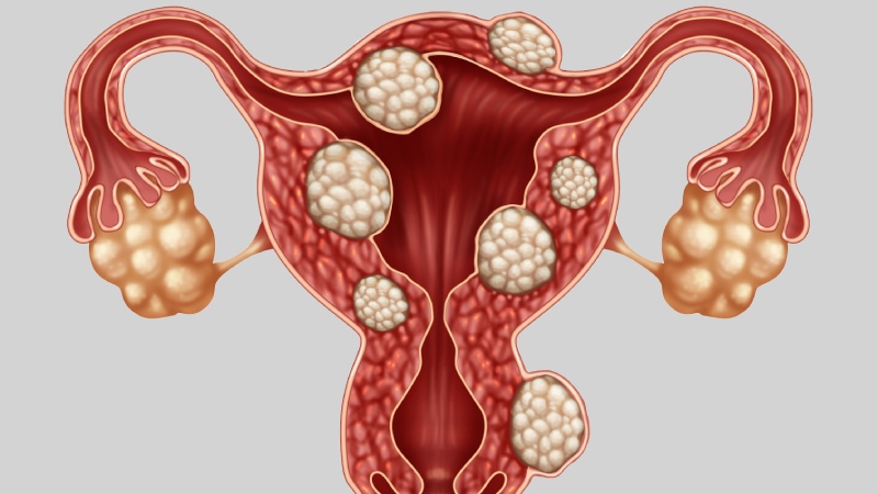 اندومتریوز چیست و چرا ممکن است با سلامت متابولیک ارتباط داشته باشد؟