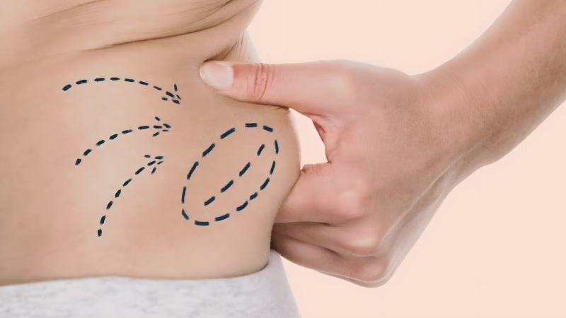 تفاوت لیپوماتیک با ابدومینوپلاستی چیست؟