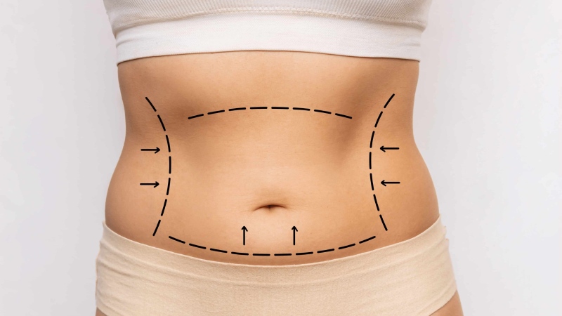 لیپوماتیک برای لاغری مناسب است؟ تفاوت تخلیه چربی با جراحی چاقی چیست؟